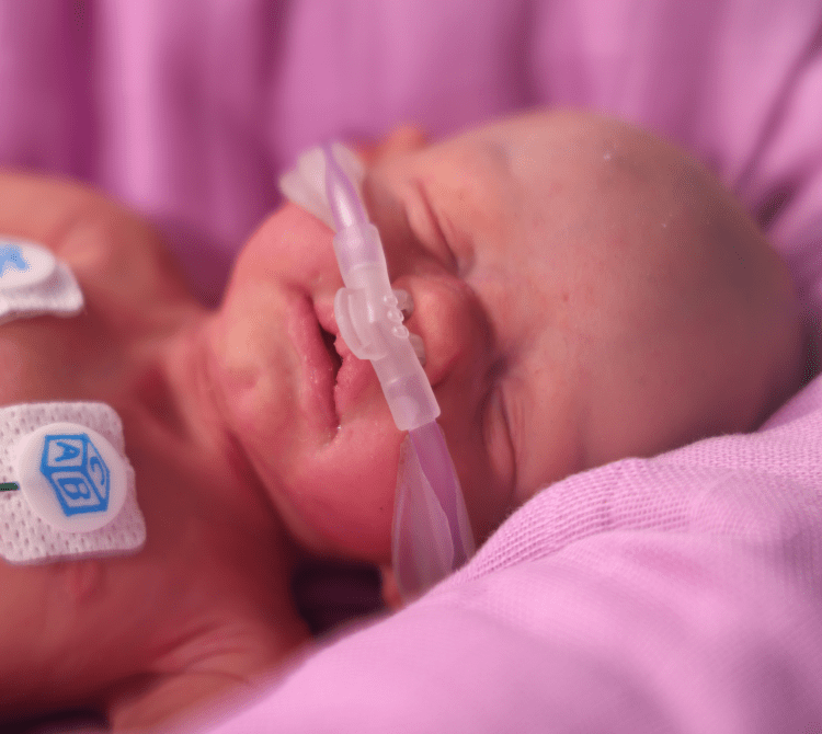 Neonate wearing a nasal cannula receiving High Flow Oxygen Therapy