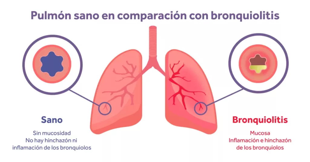 INSPIRE Tratamiento de la bronquiolitis ¿que dice la evidencia Armstrong Medical | Medical Device Manufacturer