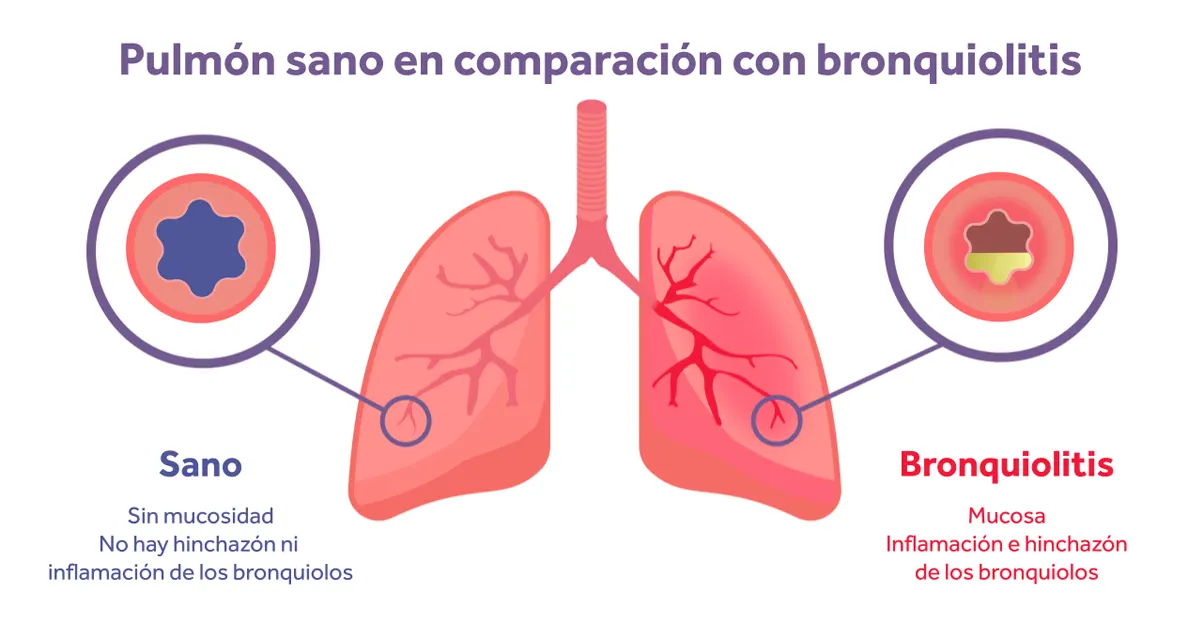 Tratamiento de la bronquiolitis, ¿qué dice la evidencia?