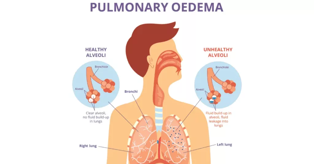 Diagram of pulmonary edema and its effects on the lungs