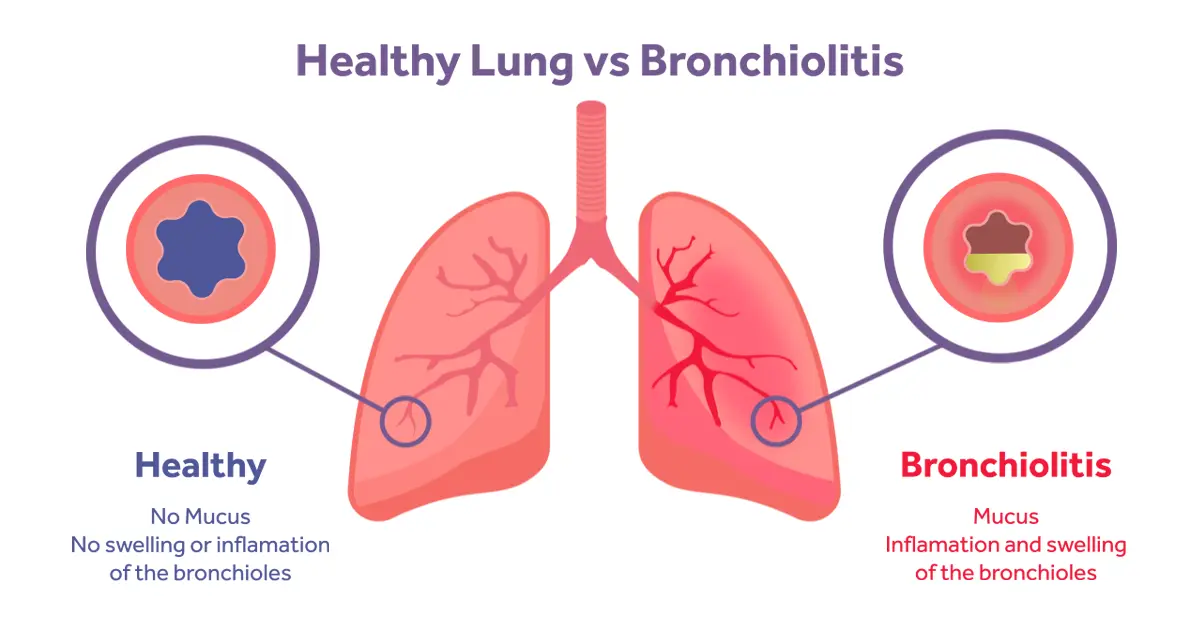 Management of Bronchiolitis, what does the evidence say?